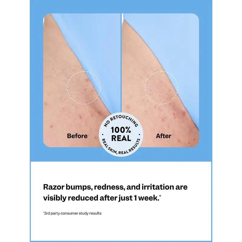 🔥Special Price £9.99 Only Today!!!🍃 Smoothing Solution Ingrown Hair Treatment