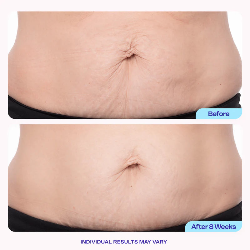 NATRAVOR® Tighten & Smooth Belly Cream