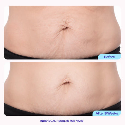 NATRAVOR® Tighten & Smooth Belly Cream