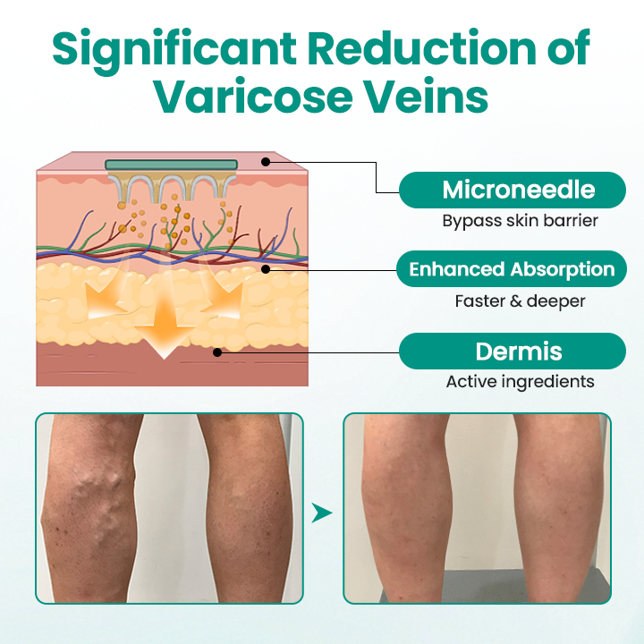NATRAVOR® LegRenew Varicose Veins Patch
