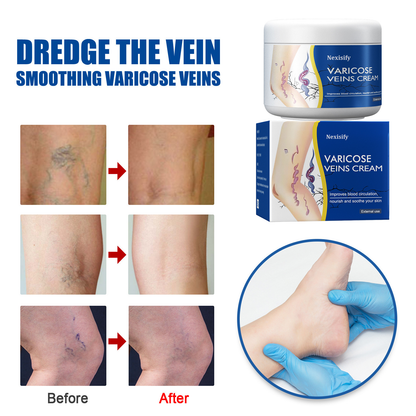 Leg Relief Varicose Veins Cream 50g – Soothing Lotion for Pain, Swelling & Circulation